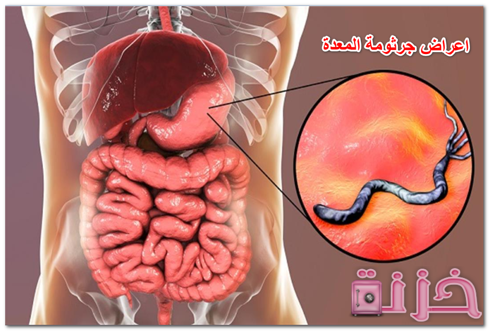 اعراض جرثومة المعدة