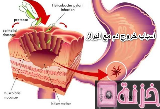 اسباب خروج دم مع البراز